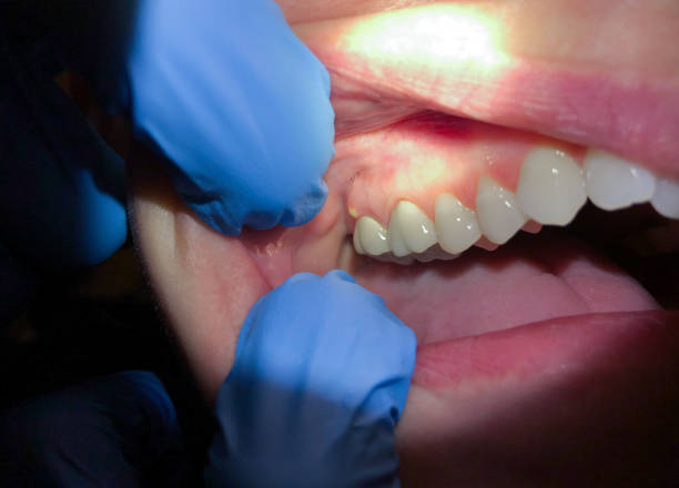 Best Emergency Dental Care for Abscessed Tooth in Daniels, WV